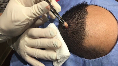 A Pilar Cyst and a Button Blackhead Are No Match for Dr. Pimple Popper