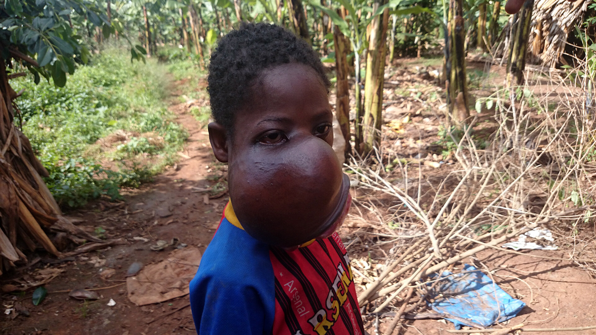 Extraordinary People S12 E01 – Erick: The Boy with no Face